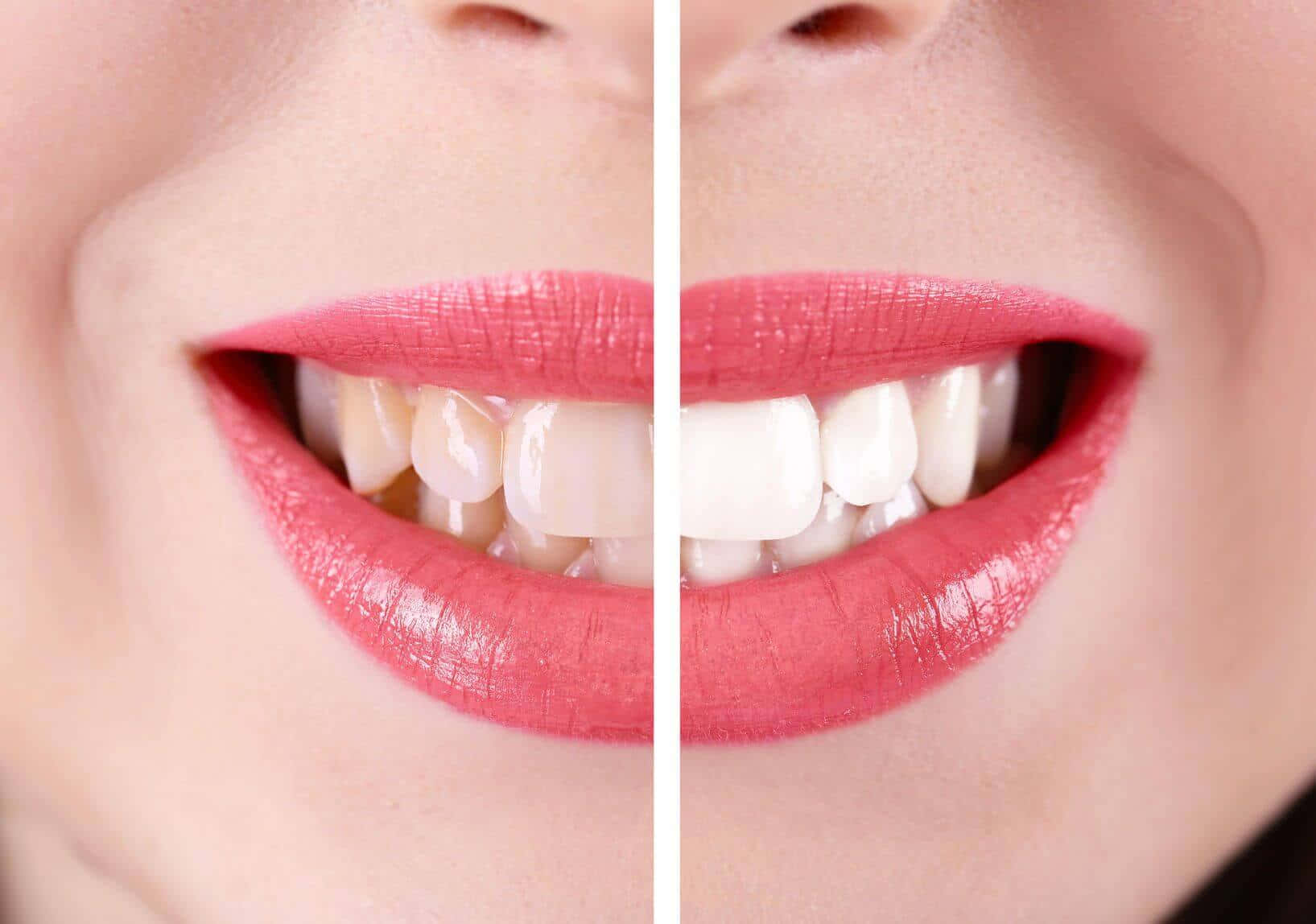 Achieve Your Brightest Smile With Professional Teeth Whitening