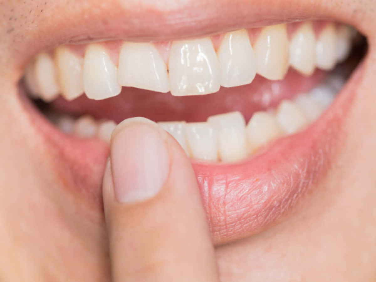 Bring Back The Radiance Of Your Pearly Whites With Teeth Whitening Wallpaper