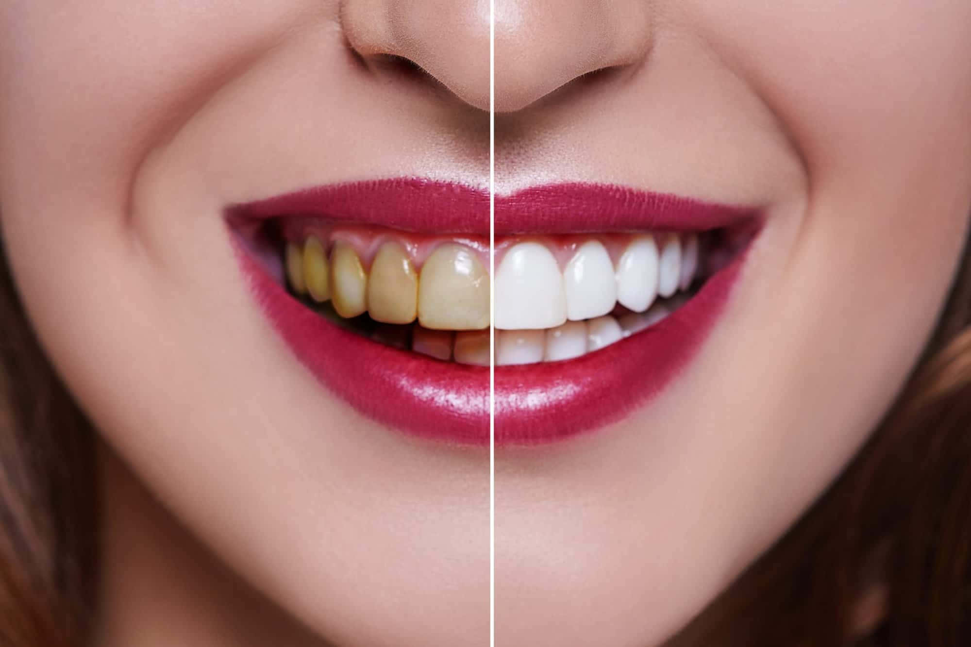 Get A Beautiful And Confident Smile With Teeth Whitening Wallpaper