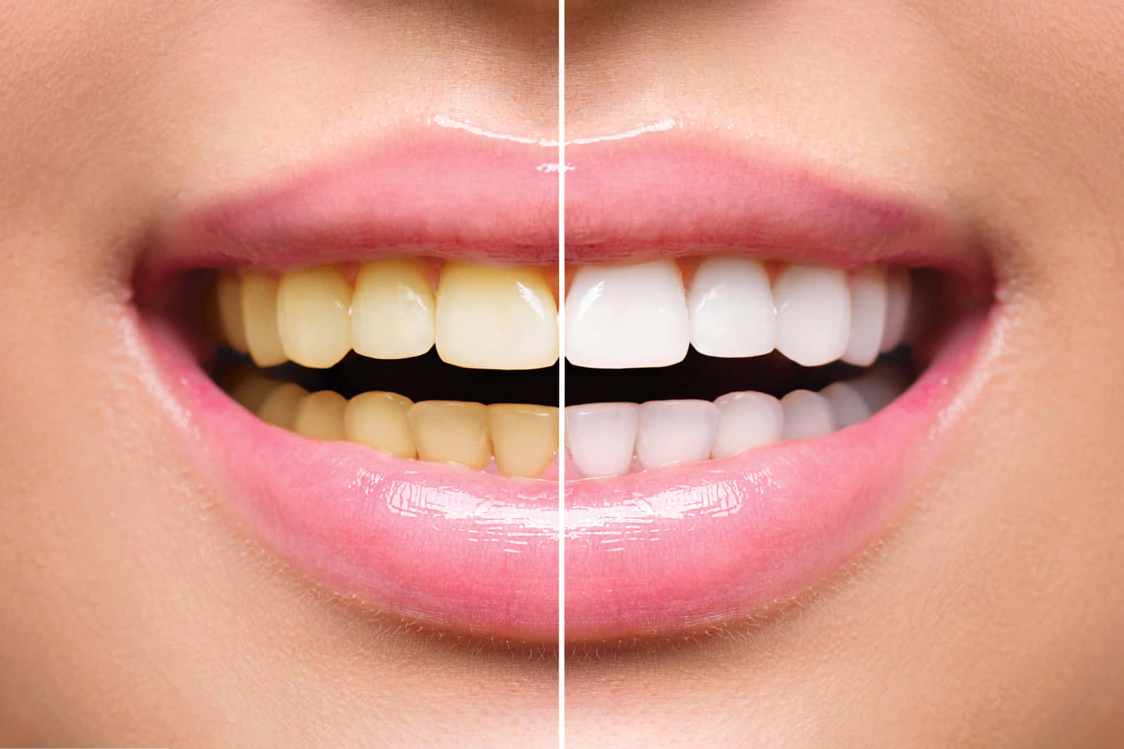 Improve Your Smile With Professional Teeth Whitening Treatment Wallpaper