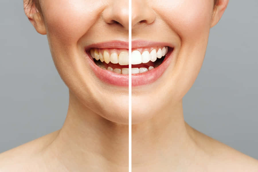 Get The Brightest Smile With Teeth Whitening Wallpaper