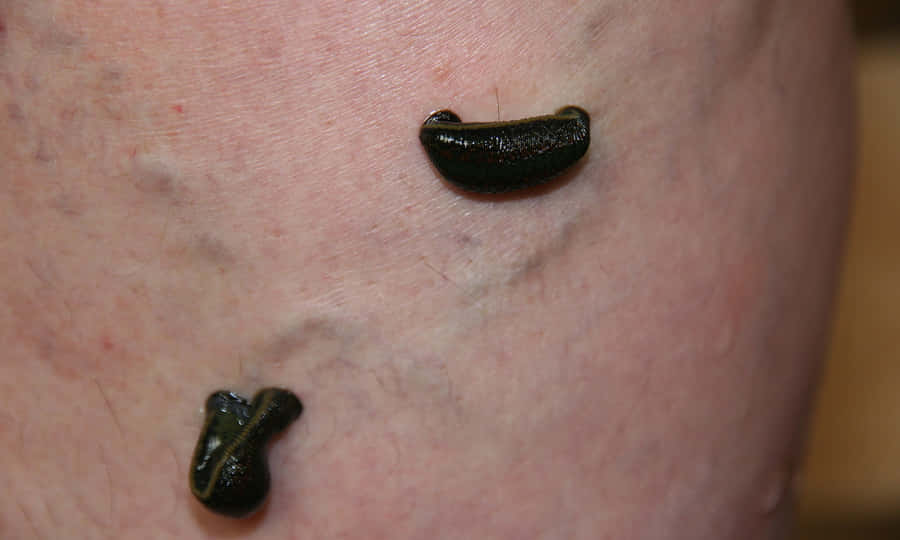 Medical Leech Therapyon Skin.jpg Wallpaper