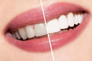 A Bright Smile With Teeth Whitening Wallpaper