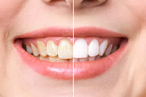 Achieve A Brighter Smile With Teeth Whitening Wallpaper