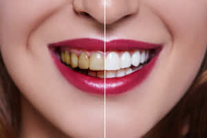 Get A Beautiful And Confident Smile With Teeth Whitening Wallpaper