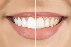 Get A Brighter Smile With Professional Teeth Whitening! Wallpaper