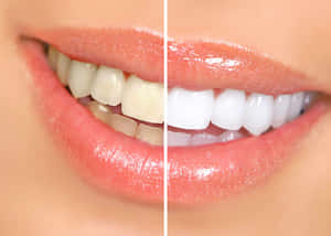 Get A Pearly White Smile With Teeth Whitening Treatments! Wallpaper