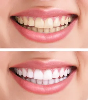 Get Brighter And Whiter Teeth With Our Professional Teeth Whitening Services! Wallpaper