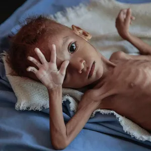 Heart-wrenching Image Of An Emaciated Boy Wallpaper