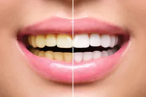 Improve Your Smile With Professional Teeth Whitening Treatment Wallpaper