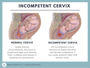 Incompetent Cervix Wallpaper