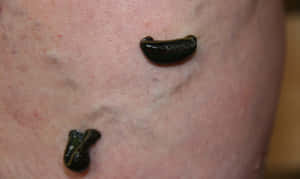 Medical Leech Therapyon Skin.jpg Wallpaper