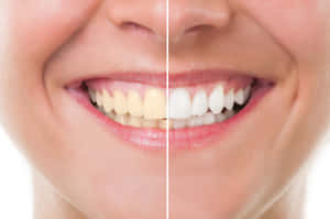 Professional Teeth Whitening For Healthier And Brighter Smile Wallpaper