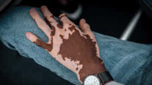 Vitiligo Hand Wrist Watch Wallpaper